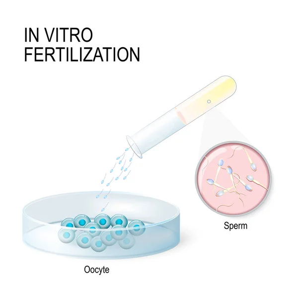 In vitro bevruchting. kunstmatige inseminatie — Stockvector