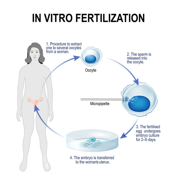 In vitro megtermékenyítés — Stock Vector