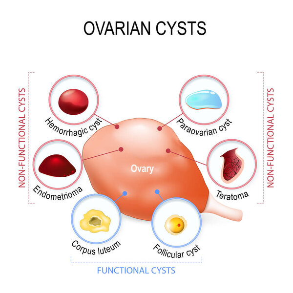 Ovarian cyst, follicle and Corpus luteum.