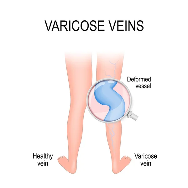 Vena varicosa y vena normal — Vector de stock