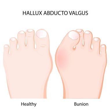 hallux valgus abducto. sağlıklı eklem ve şişik