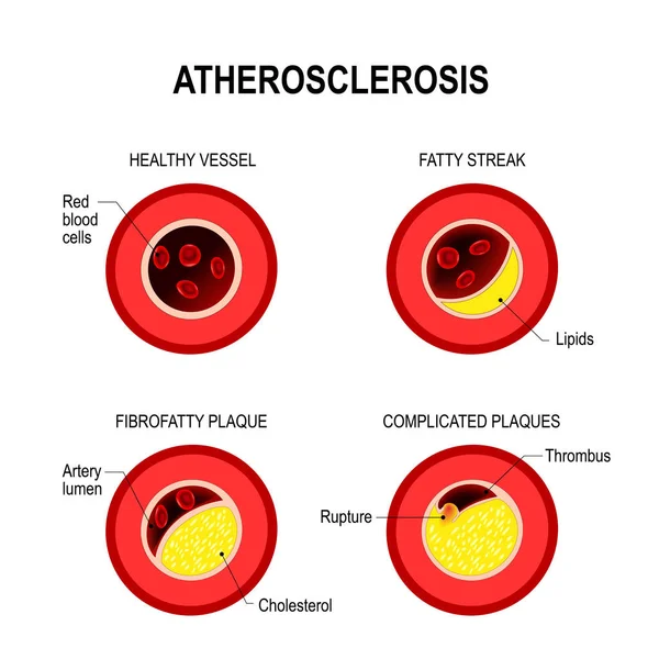Estágios da aterosclerose . — Vetor de Stock