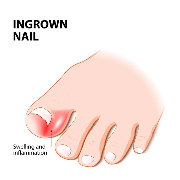 Inåtväxta naglar. Nail sjukdom — Stock vektor