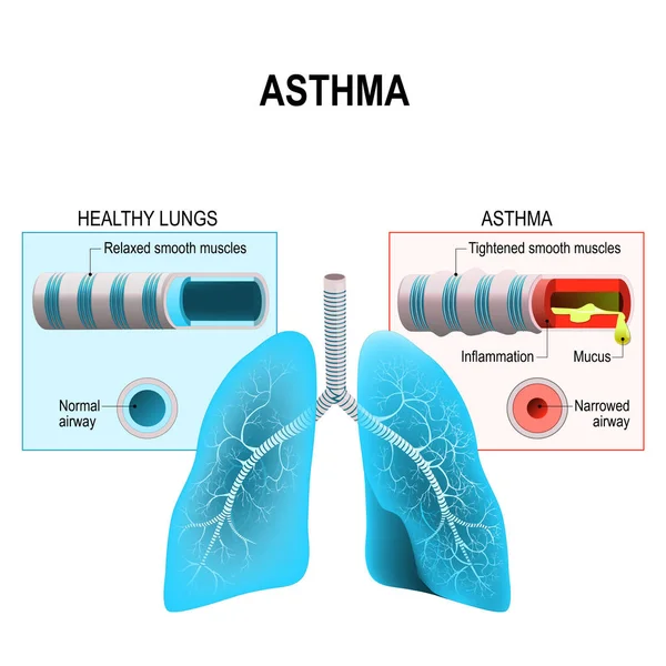Asma. Pulmões e brônquios humanos — Vetor de Stock