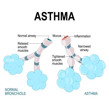 astım. alveoller ve bronchiole. 