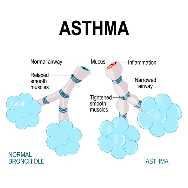 Asma. alvéolos y bronquiol . — Vector de stock