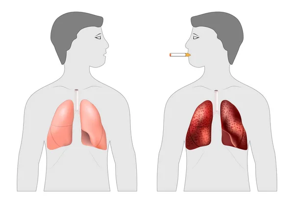 Plakát o škody způsobené kouřením. Kuřáka a zdravé plíce — Stockový vektor