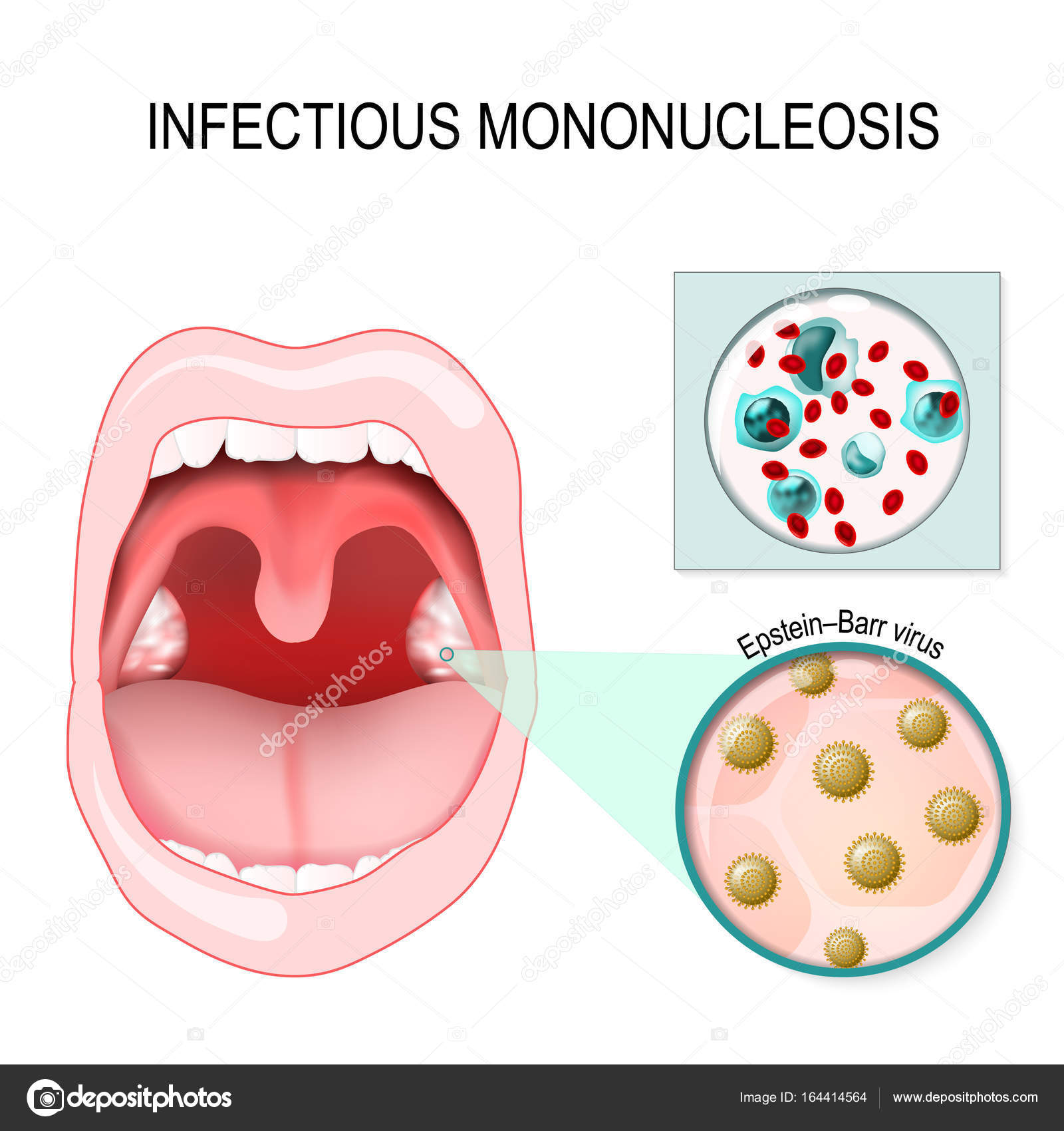 Мононуклеоз вирус эпштейна. Мононуклеоз Эпштейна-Барр. Инфекционный мононуклеоз (инфекция вирусом Эпштейна — Барра).