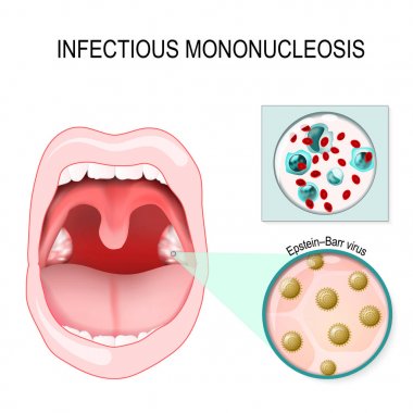 infectious mononucleosis. vector clipart