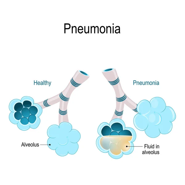 Pneumonia. A ilustração mostra alvéolos normais e infectados . — Vetor de Stock