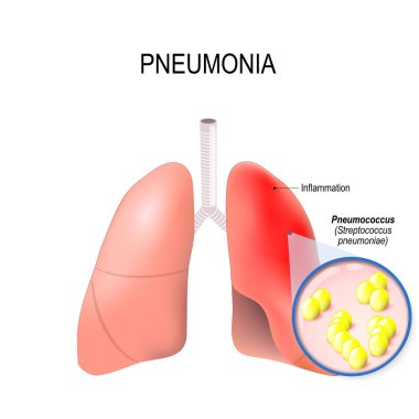 Pneumonia. Normal and inflammatory condition of the lung.  clipart