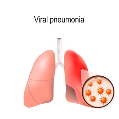 Viral pnömoni. İnsan lun normal ve inflamatuar durumu