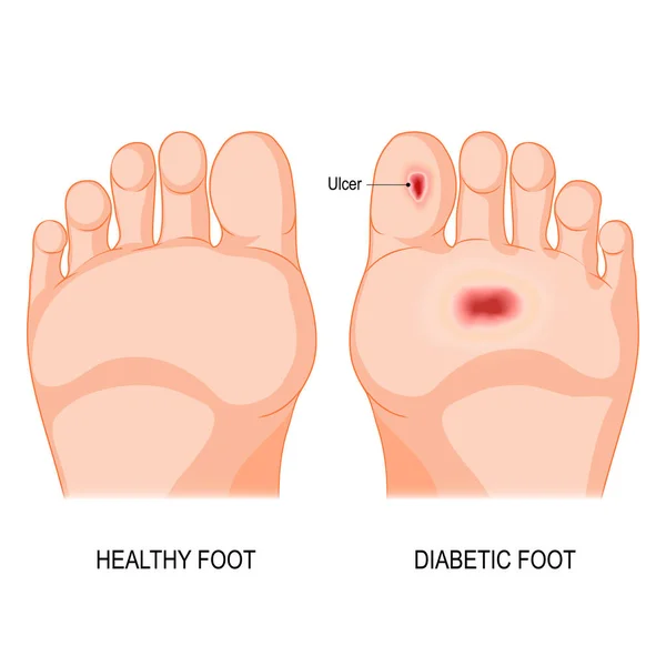 Diabetische voet. vectorillustratie — Stockvector