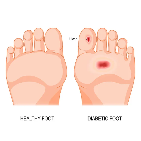 Piede diabetico. Illustrazione vettoriale — Vettoriale Stock