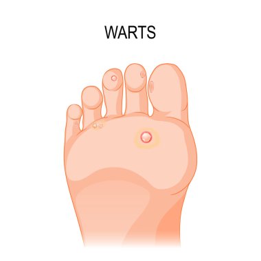 Foot wart. vector illustration clipart