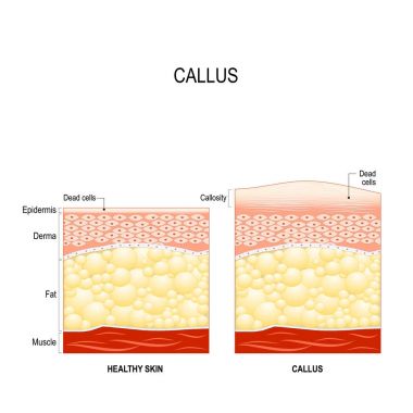 Callus. callosity. The difference between healthy skin and skin with callus clipart