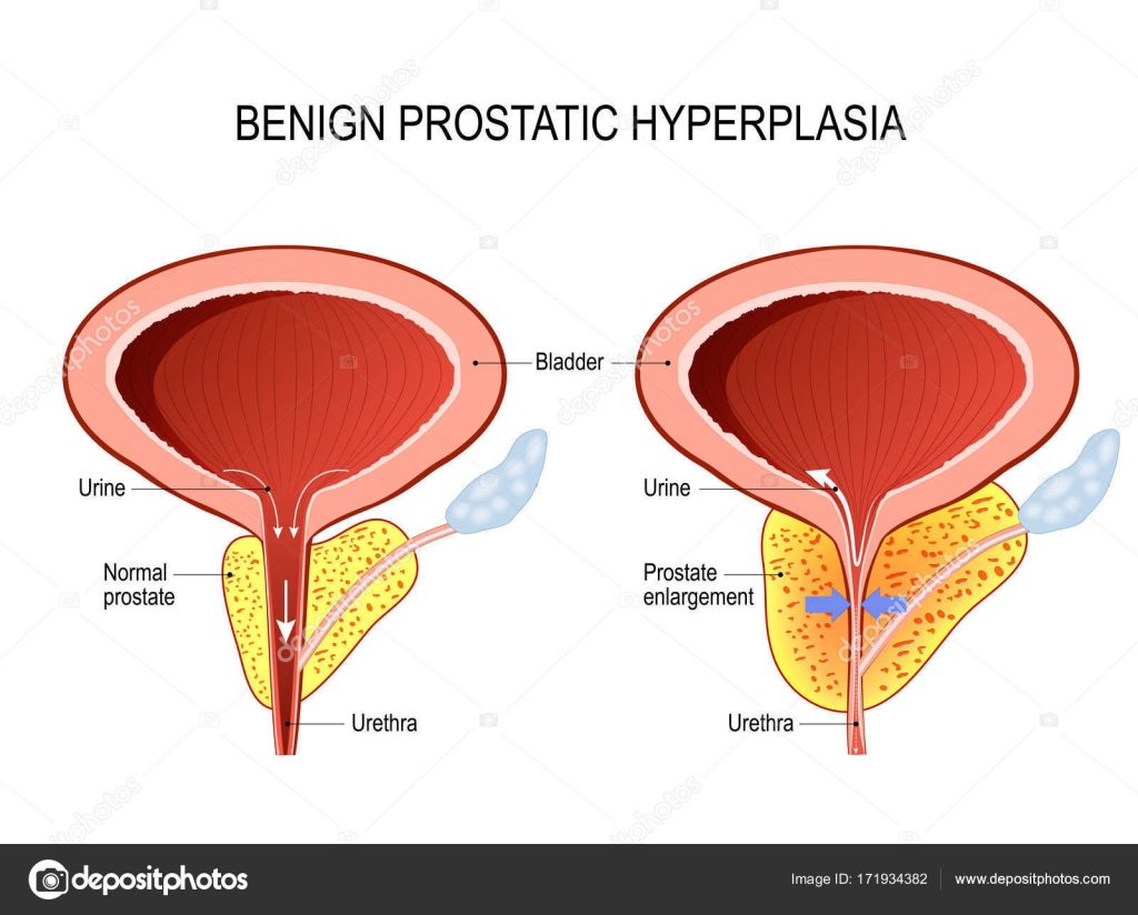 Prostatitis prosztata hyperplasia