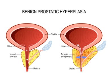 Benign Prostat Hiperplazisi (Bph). Prostat büyümesi