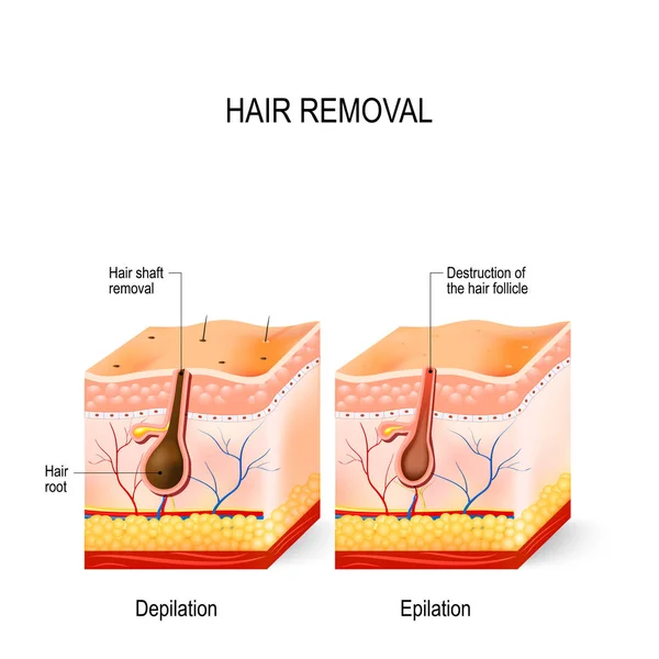 Het verschil tussen epileren en epilatie. — Stockvector