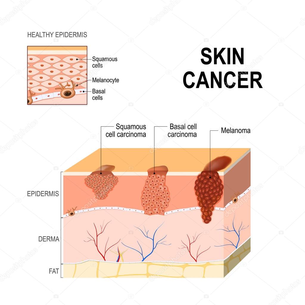Skin cancer. Squamous cell carcinoma, basal-cell cancer and Mela