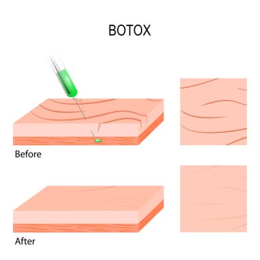 Botox. estetik dolgu