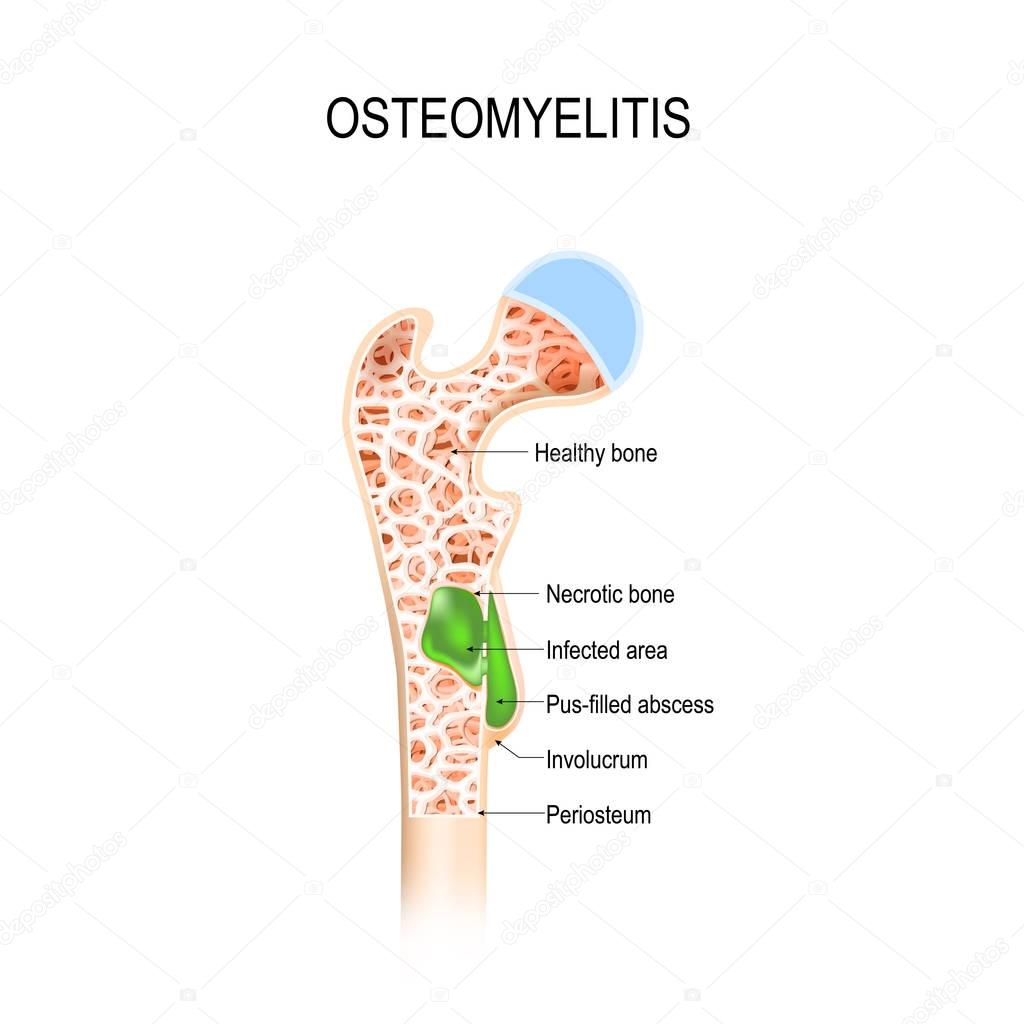 Osteomyelitis is infection in the bone
