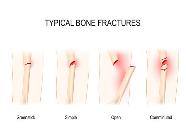 Typical bone fractures.