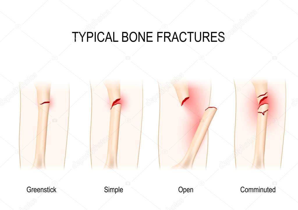 Typical bone fractures.