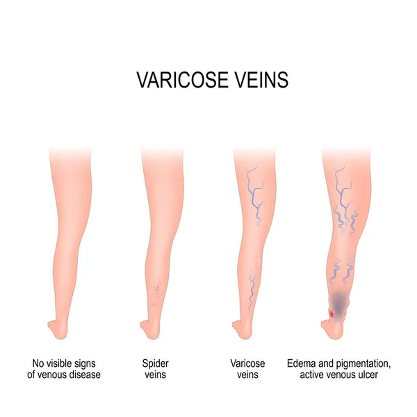 Étapes des varices . — Image vectorielle