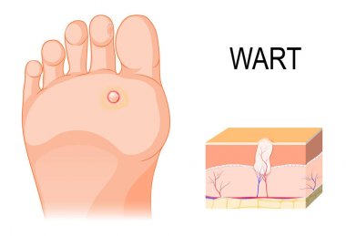 Foot warts on the bottom of soles and toes. Cross section of a c clipart
