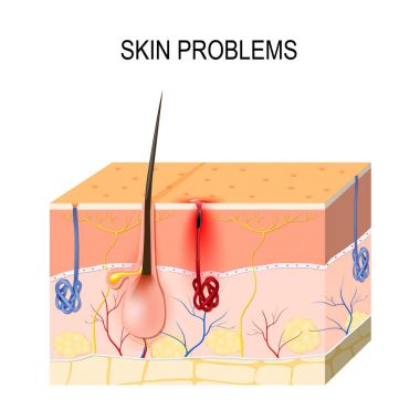 Cilt sorunları. Tıkanmış gözenekleri