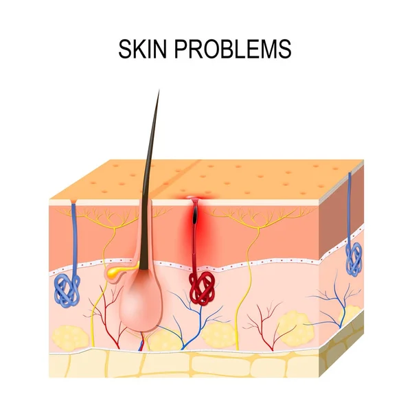 Problèmes de peau. Pores bloqués — Image vectorielle