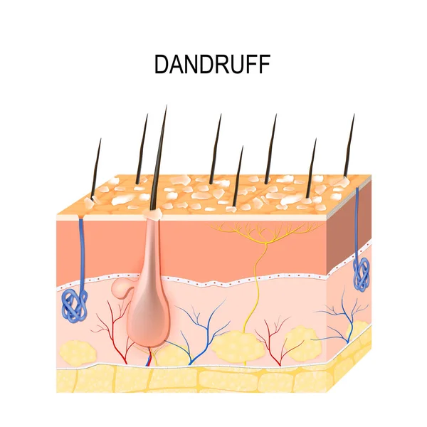 Dandruff. seborrheic dermatitis — Stock Vector