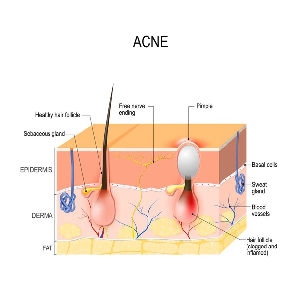 Acne vulgaris. puistje. — Stockvector