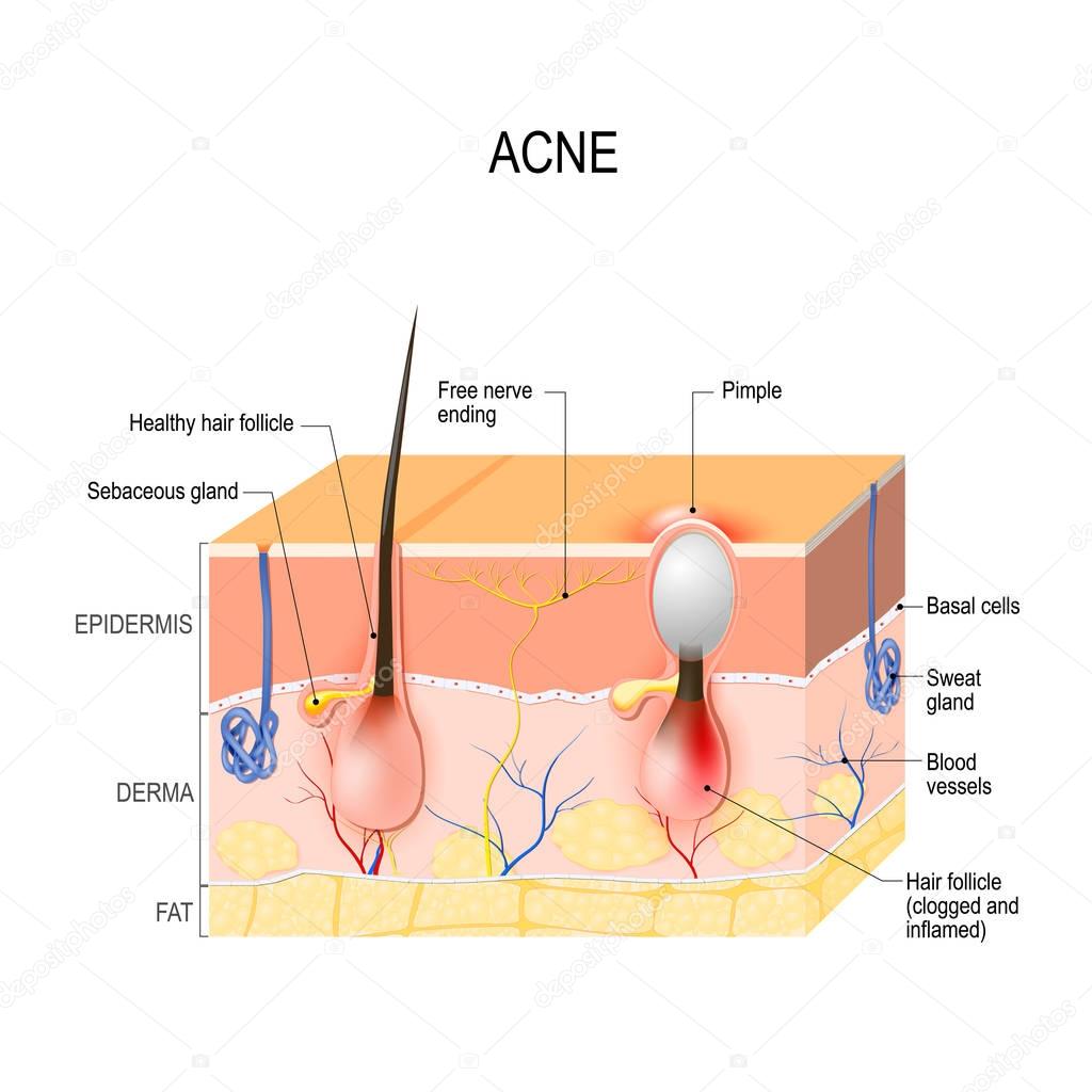 Acne vulgaris. pimple.