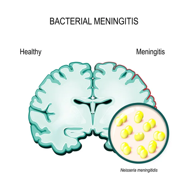 Meningitis. Cerebro humano y bacterias meningocócicas . — Archivo Imágenes Vectoriales