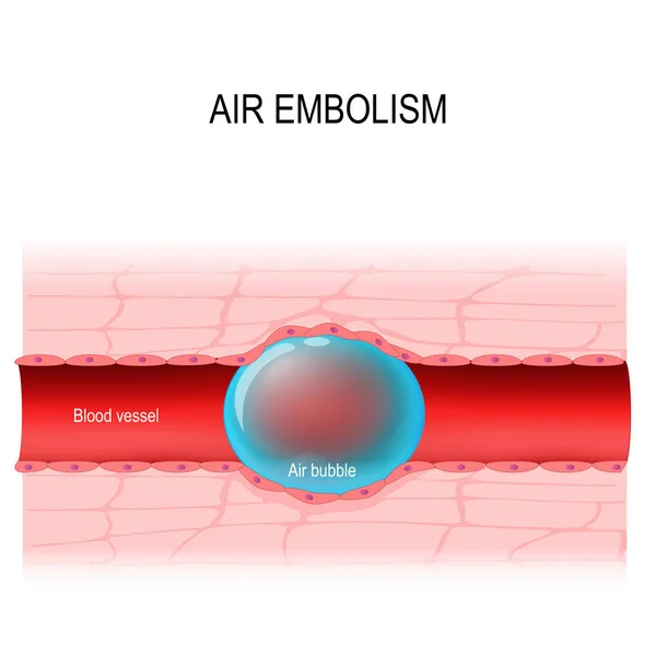 Air embolism  is a blood vessel blockage — Stock Vector