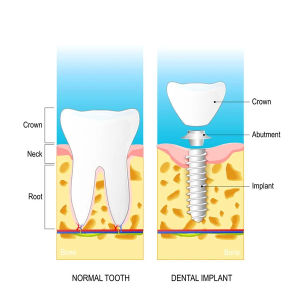 Diş implantı vektör diyagramı tıbbî kullanım için — Stok Vektör