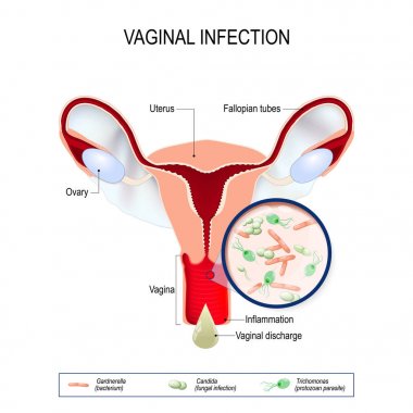 vaginal infection and causative agents of vulvovaginitis. clipart