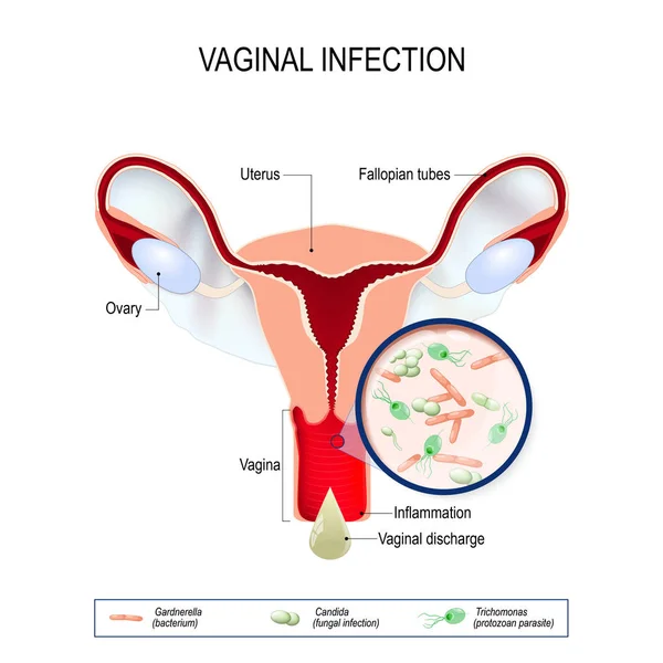 Infeção vaginal e agentes causadores da vulvovaginite . — Vetor de Stock