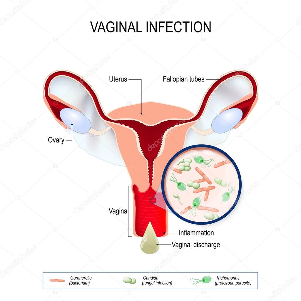 vaginal infection and causative agents of vulvovaginitis.