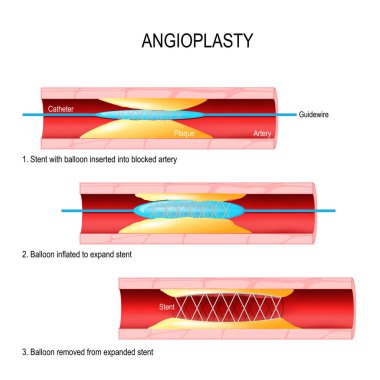 Angioplasty. Stent Implantation. clipart
