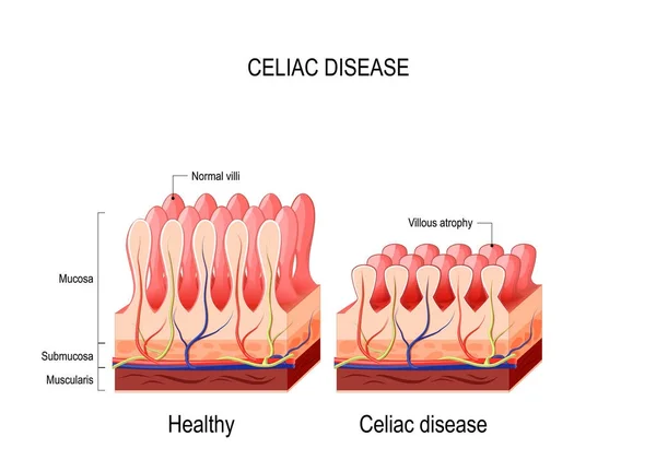 Celiachia. celiachia . — Vettoriale Stock