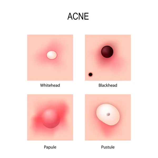 Acne vulgaris. estágios de desenvolvimento. Tipos de espinhas . —  Vetores de Stock