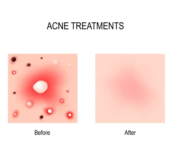 Traitement de l'acné — Image vectorielle