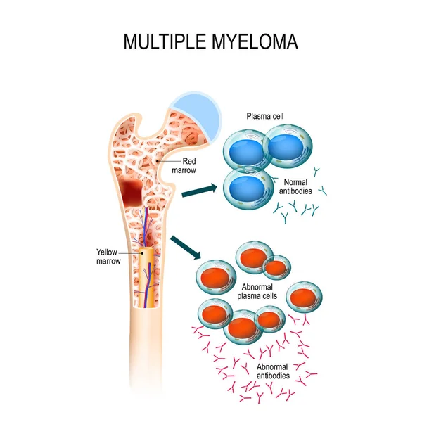 Multiple myeloma. plazma sejtek myeloma — Stock Vector