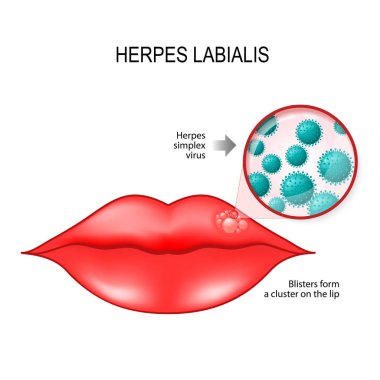 Herpes labialis dudaktan