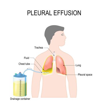 Plevral efüzyon. Gerilim hydrothorax tedavisinde