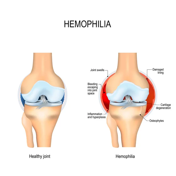 Человеческое колено с гемофилией и здоровым суставом — стоковый вектор