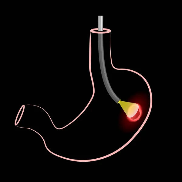 Procedimiento de gastroscopia. estómago humano con úlcera péptica, y endo — Vector de stock